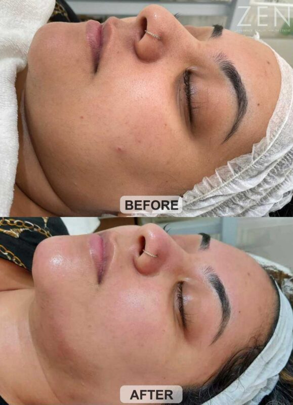 BEFORE-AFTER MESOTHERAPY | ZEN HEALTHCARE